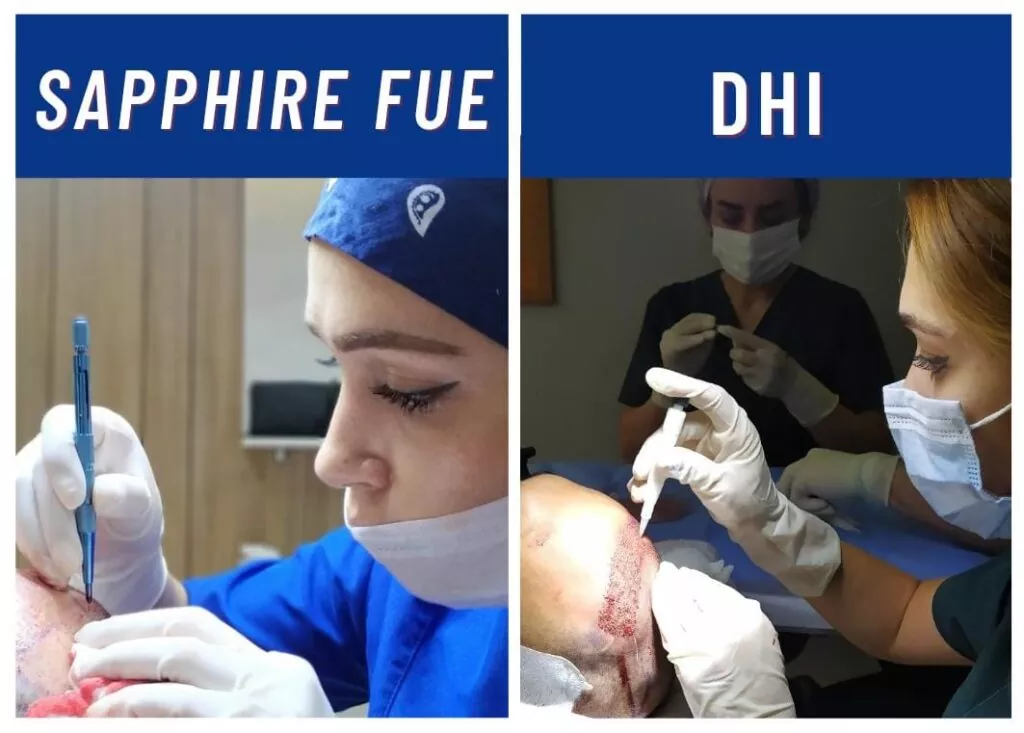 Hair Transplant with Sapphire FUE Technique or DHI Technique