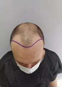 hair-transplantation-process-3
