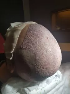 hair-transplantation-process-4