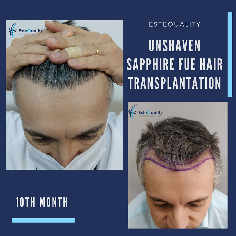 Unshaven Hair Transplant | EsteQuality