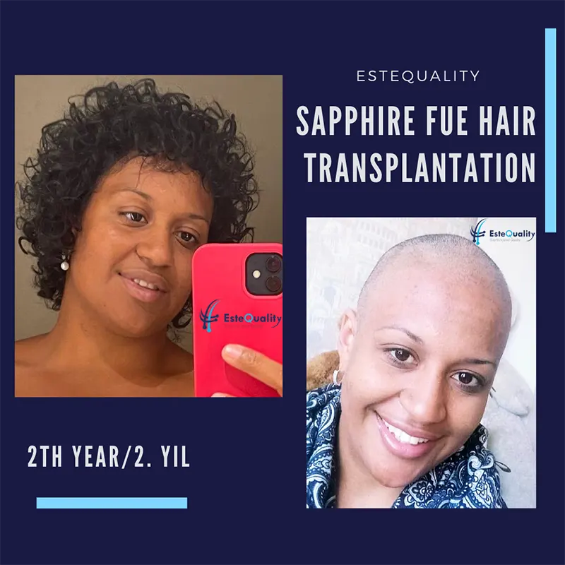 Hair Transplant For Women | EsteQuality