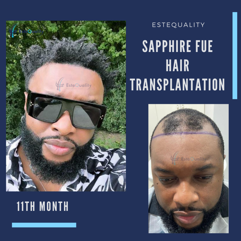 Resultado de trasplante capilar afro sapphire FUE en Turquía para un paciente masculino, antes y después de once meses