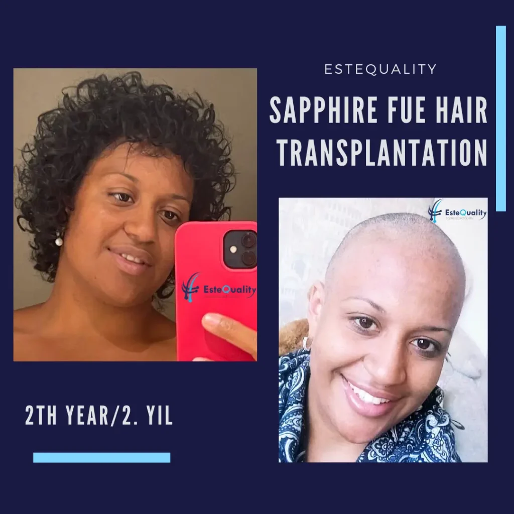Resultado de trasplante capilar afro en Turquía para una paciente femenina, antes y después de dos años