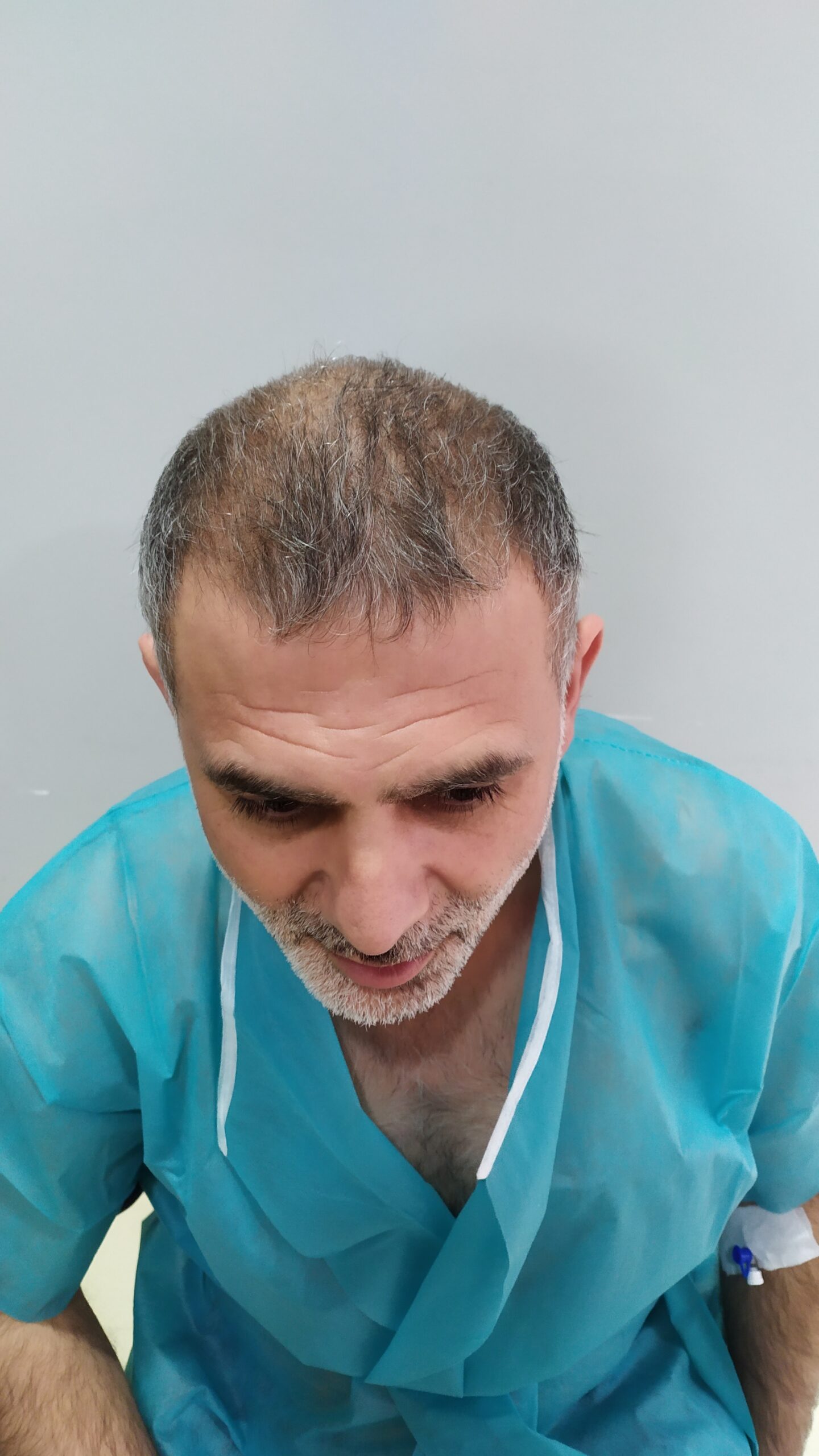 David Markovic before hair transplant