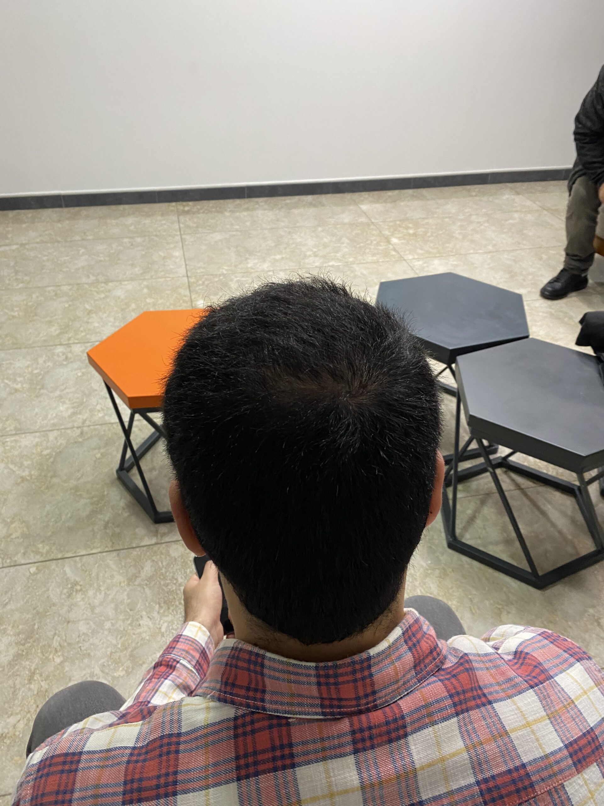 Marco Rinaldi after hair transplant angle 2