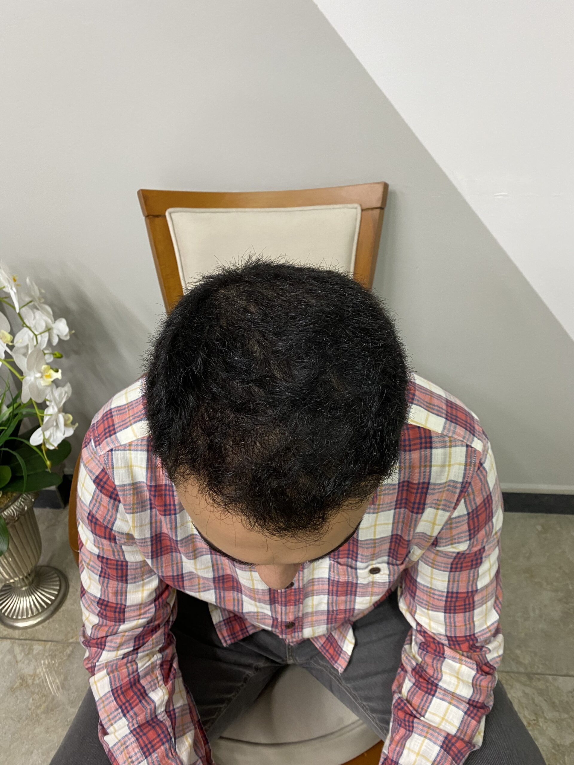 Marco Rinaldi after hair transplant