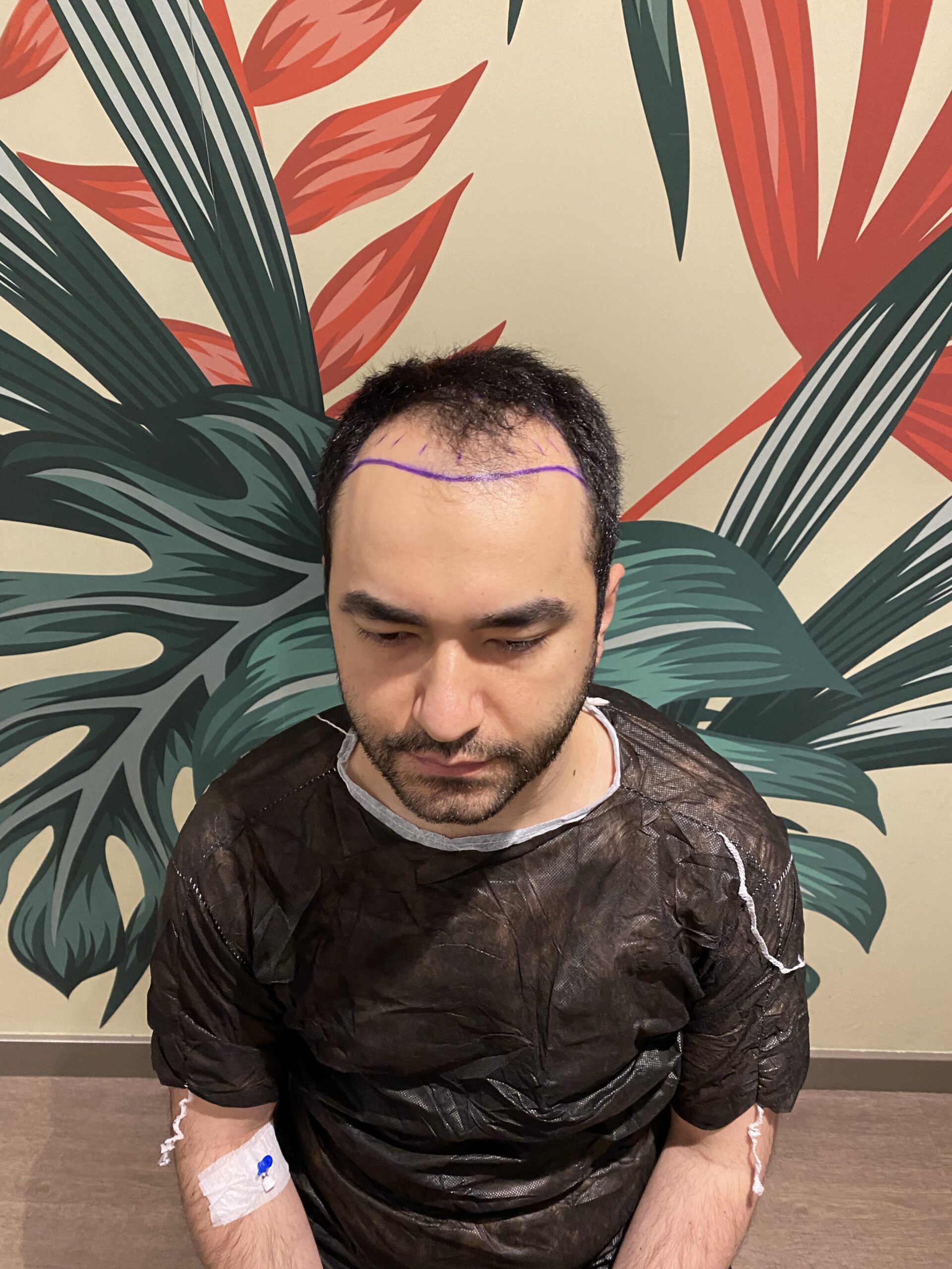 Marco Rinaldi before hair transplant angle 2