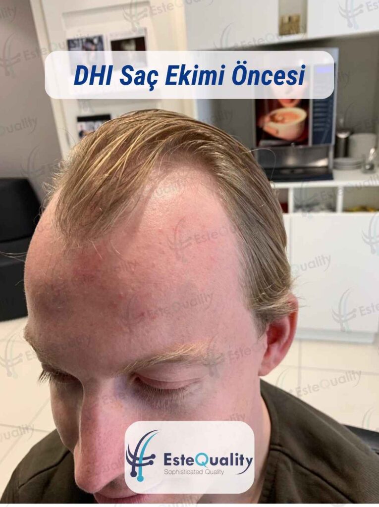 DHI Saç Ekimi Öncesi