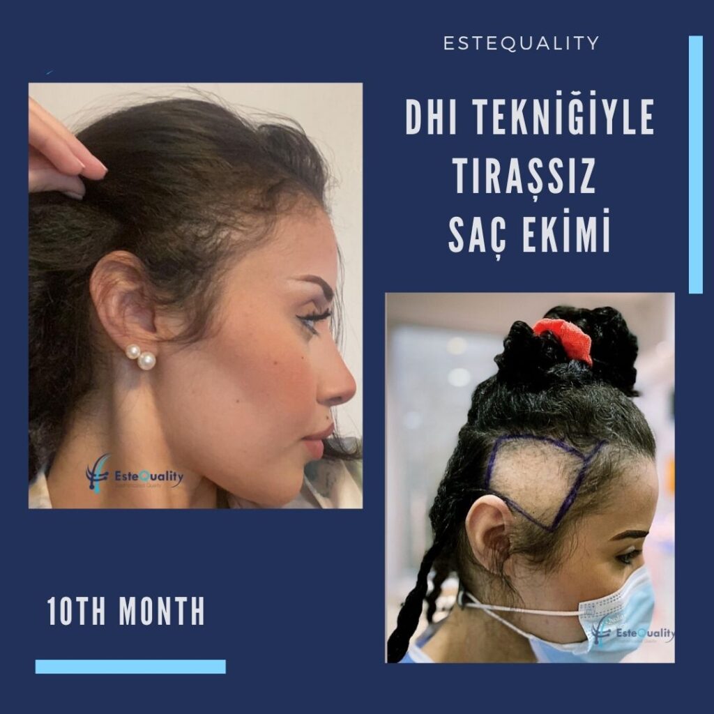 DHI kadın saç ekimi