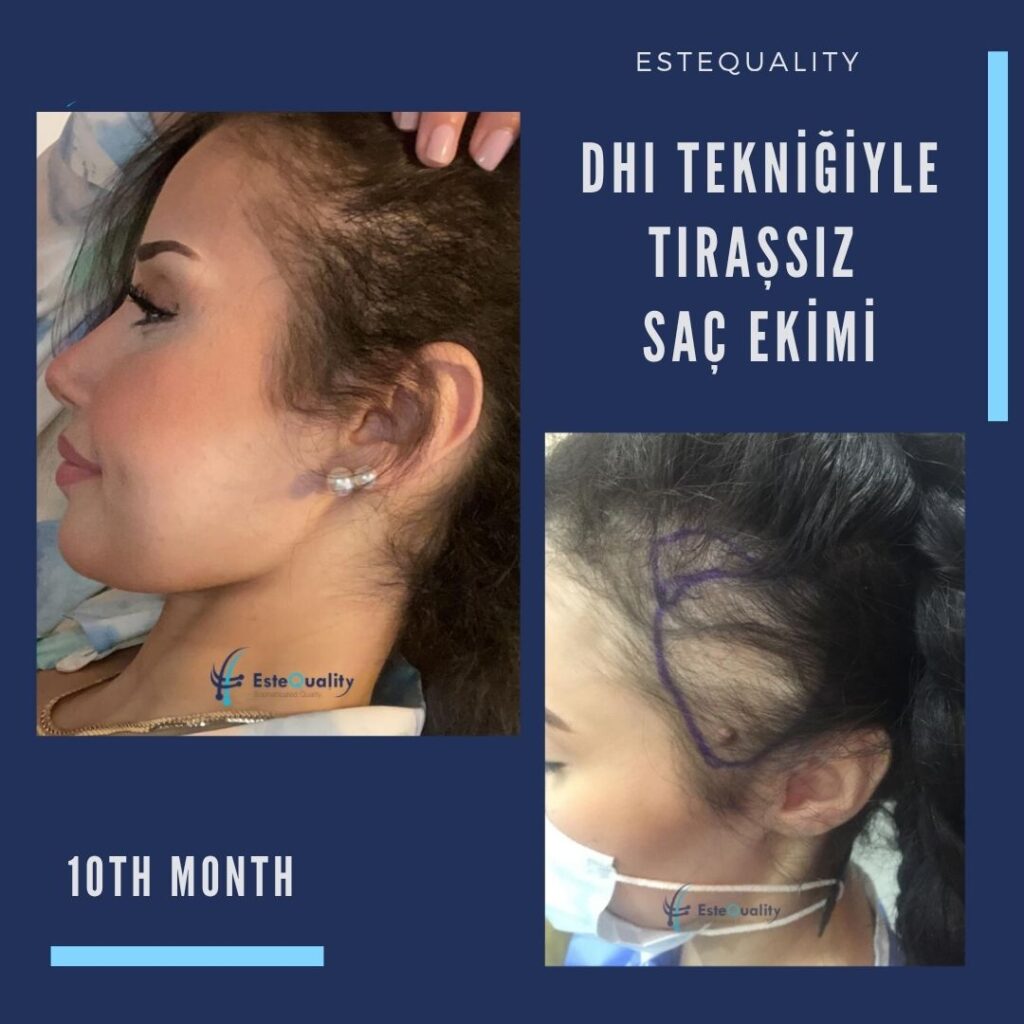 DHI tıraşsız kadın saç ekimi öncesi sonrası