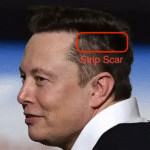 elon musk hair transplant