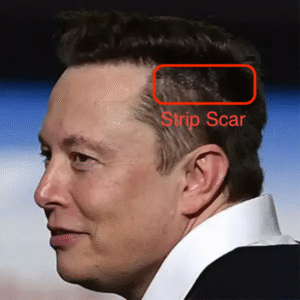 elon musk hair transplant
