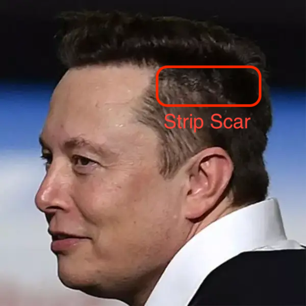 elon musk hair transplant