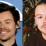 harry styles hair transplant