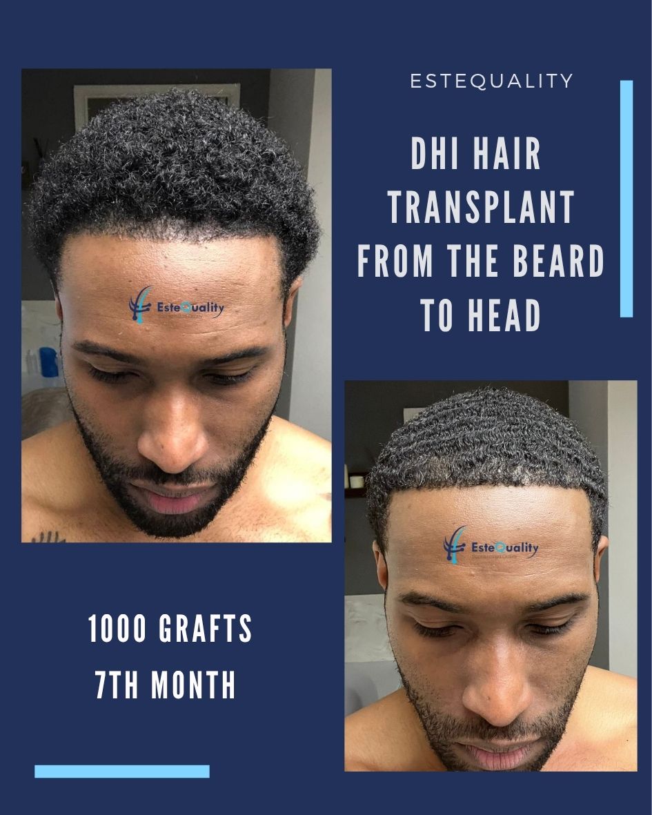 1000 grafts hair transplant before after results
