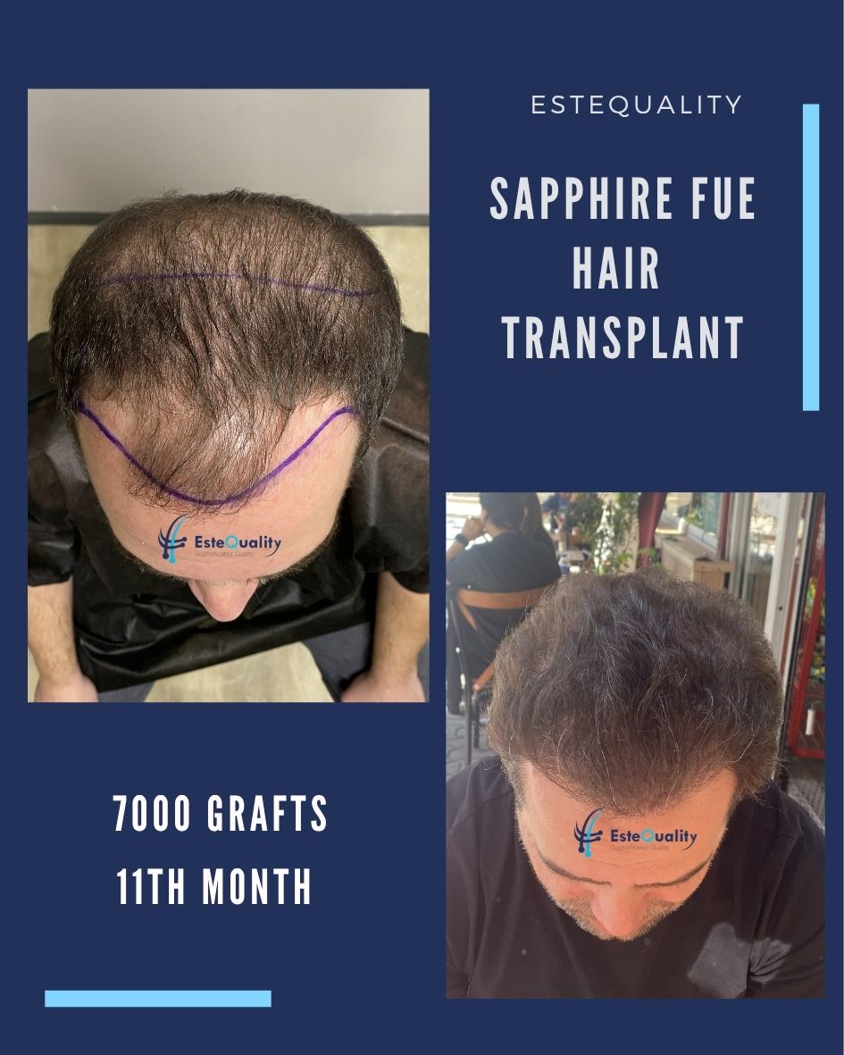 7000 grafts hair transplant before after results