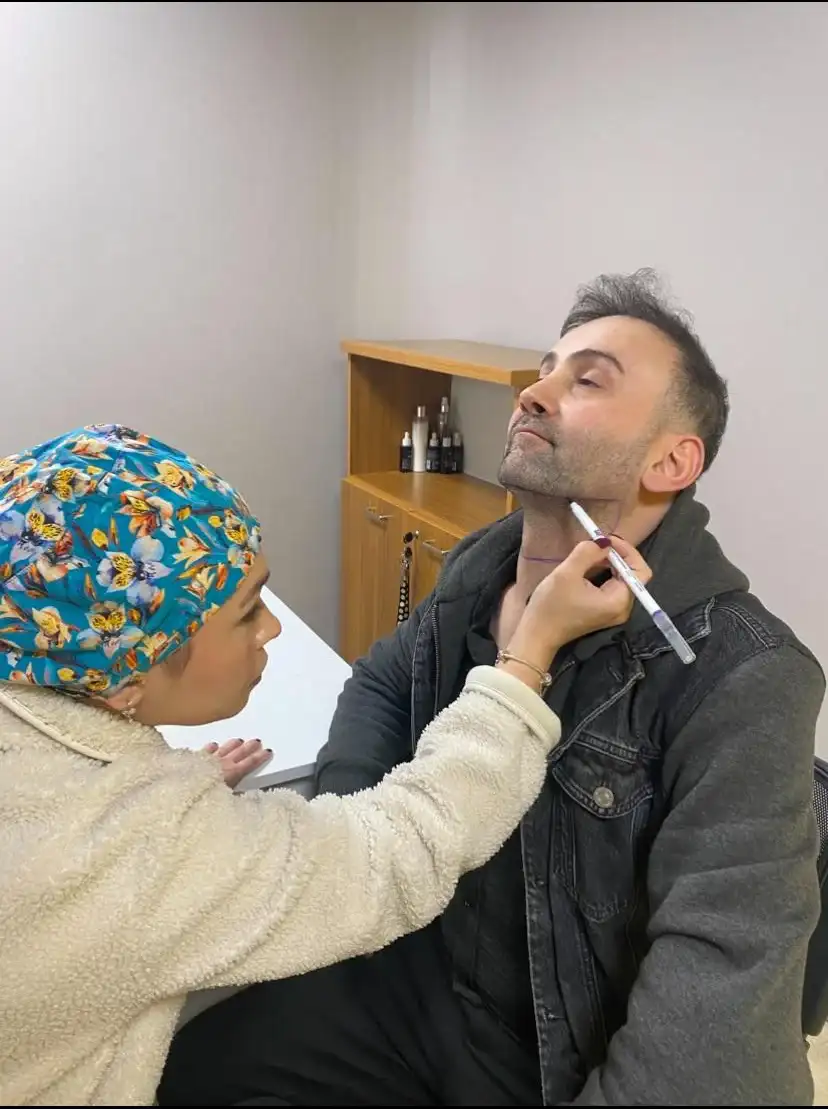 Before 1,750-graft beard-to-scalp hair transplant showing donor area preparation.