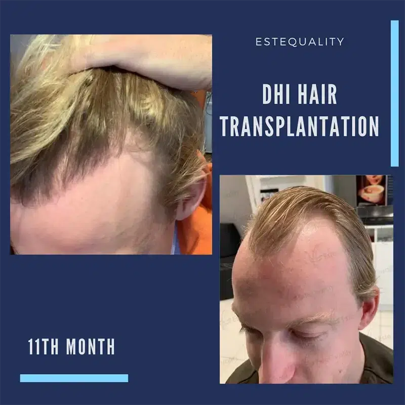 DHI Haartransplantation Vorher-Nachher – Deutlich erhöhte Haardichte und natürliche Haarlinie nach präziser Implantation mit der Choi-Pen-Technik.