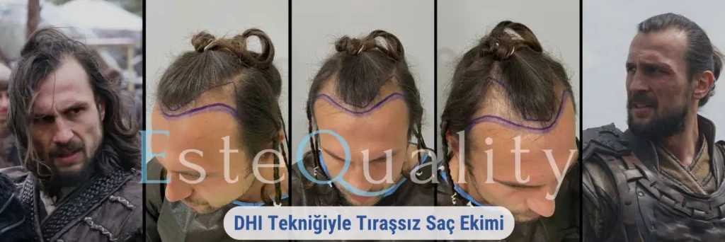 DHI Tıraşsız Saç Ekimi Öncesi ve sonrası