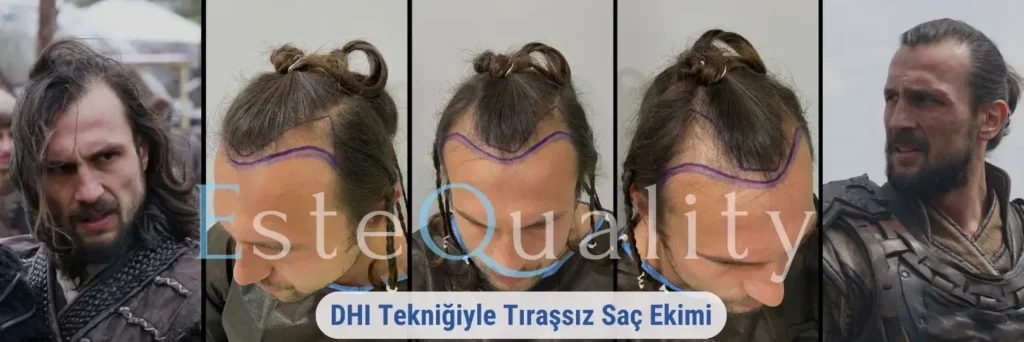 Unshaven DHI hair transplant showing natural growth and smooth recovery with Choi pen implantation technique.