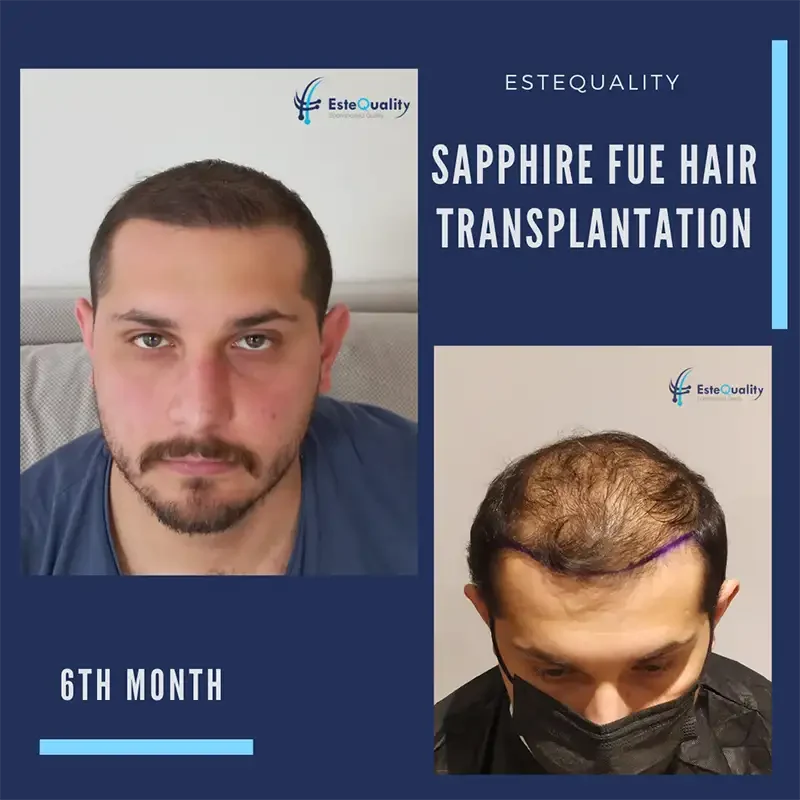 Haartransplantation 6 Monate nach dem Eingriff – Sichtbar dichteres Haar und schnelle Regeneration dank Saphir-FUE-Technik mit präzisen Mikrokanälen.