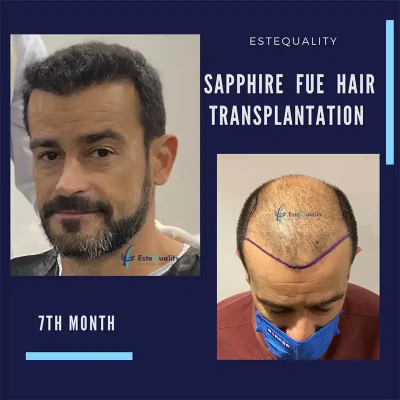 Haartransplantation 7 Monate nach dem Eingriff – Neues Haarwachstum mit natürlicher Haarlinie und schneller Heilung dank Saphir-FUE-Methode.