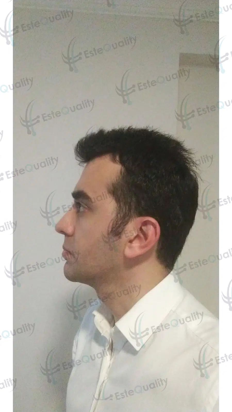 Eight months after hair transplant scar repair showing natural hairline coverage and improved density after accident trauma.