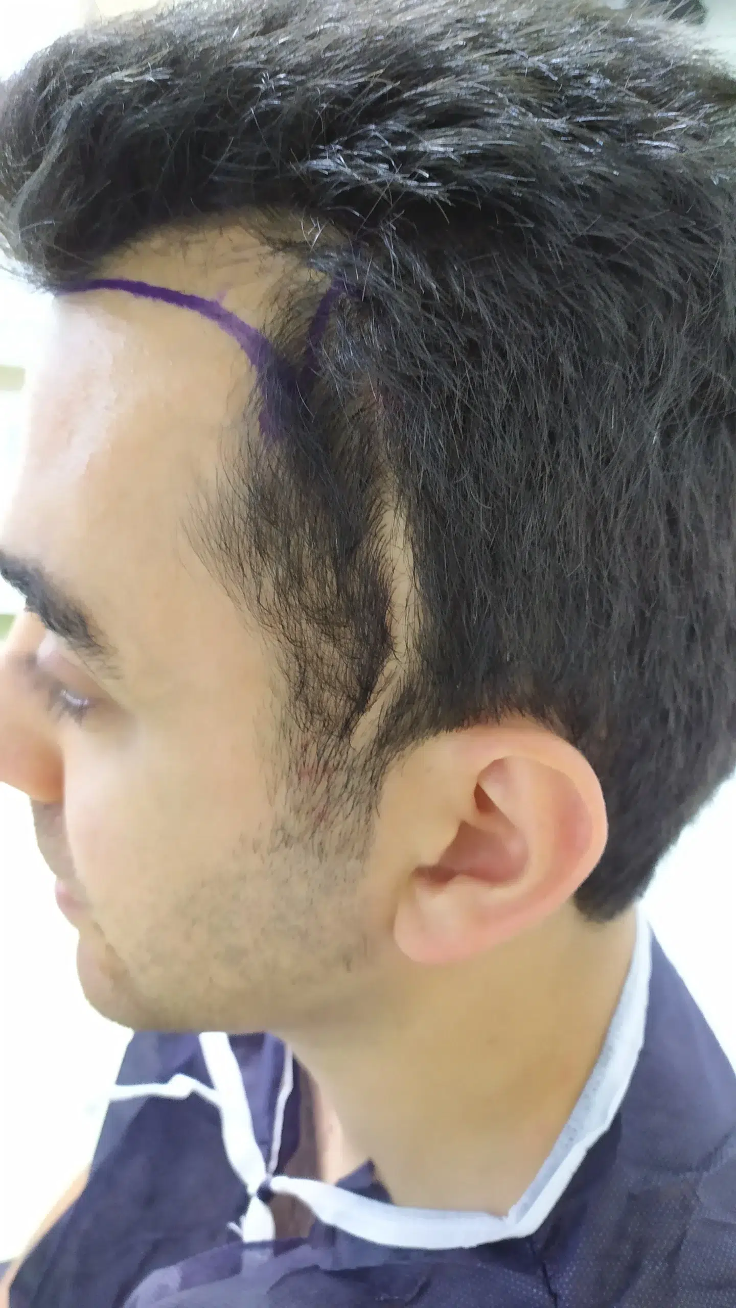 Preoperative photo showing visible scar area from accident before hair transplant scar repair.