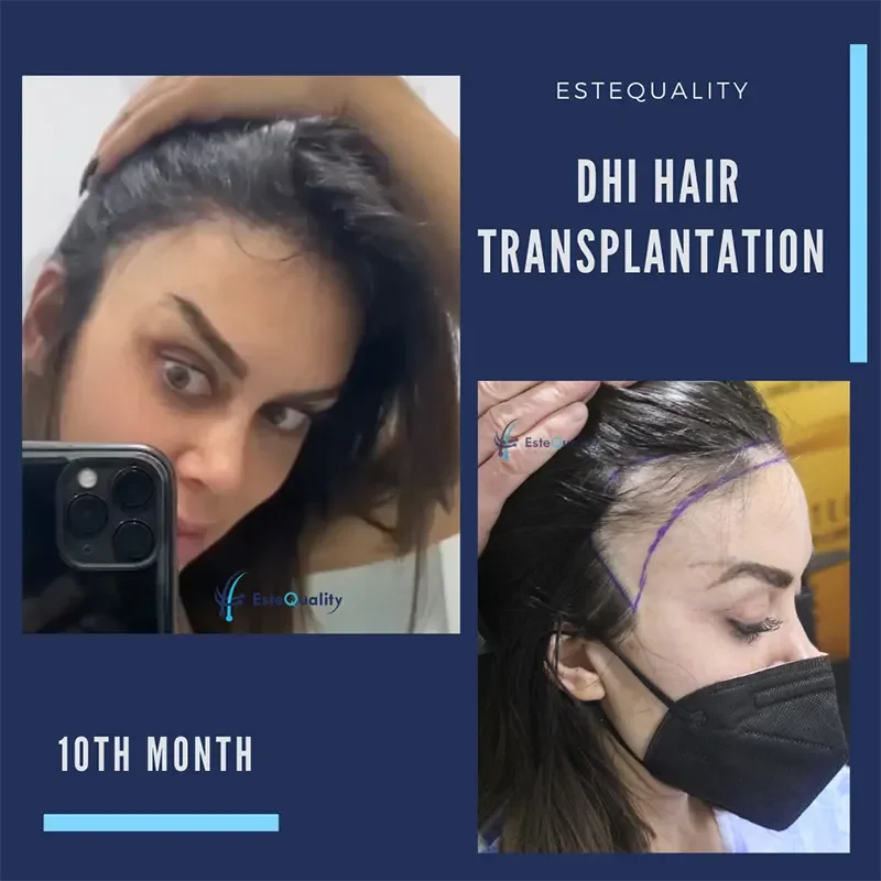 Natürliches Ergebnis einer Haartransplantation bei einer Patientin – DHI Methode nach 10 Monaten