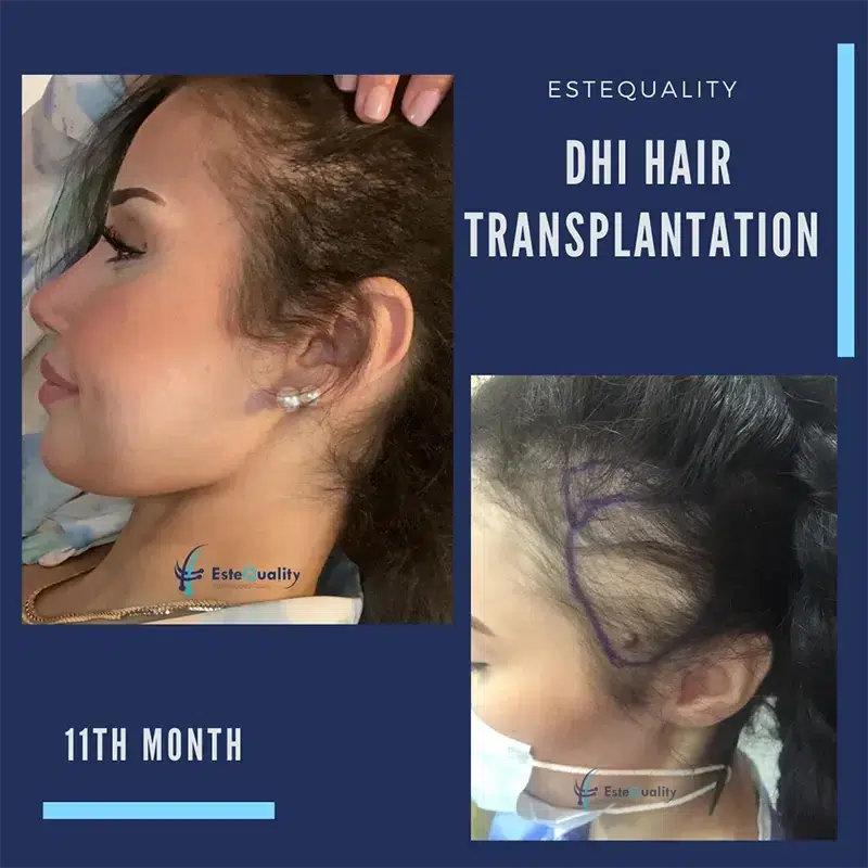 Deutlich verdichtete Haarlinie bei einer Frau nach DHI Haartransplantation – Ergebnis nach 11 Monaten