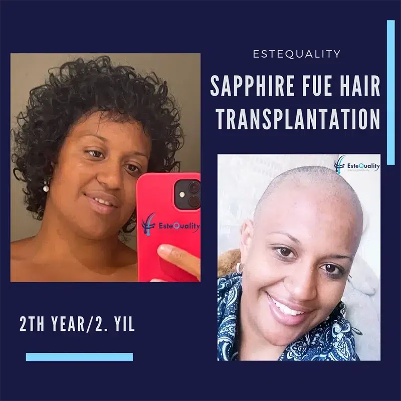 Vorher-Nachher Ergebnis einer Haartransplantation bei einer Frau mit Sapphire FUE Methode nach 2 Jahren