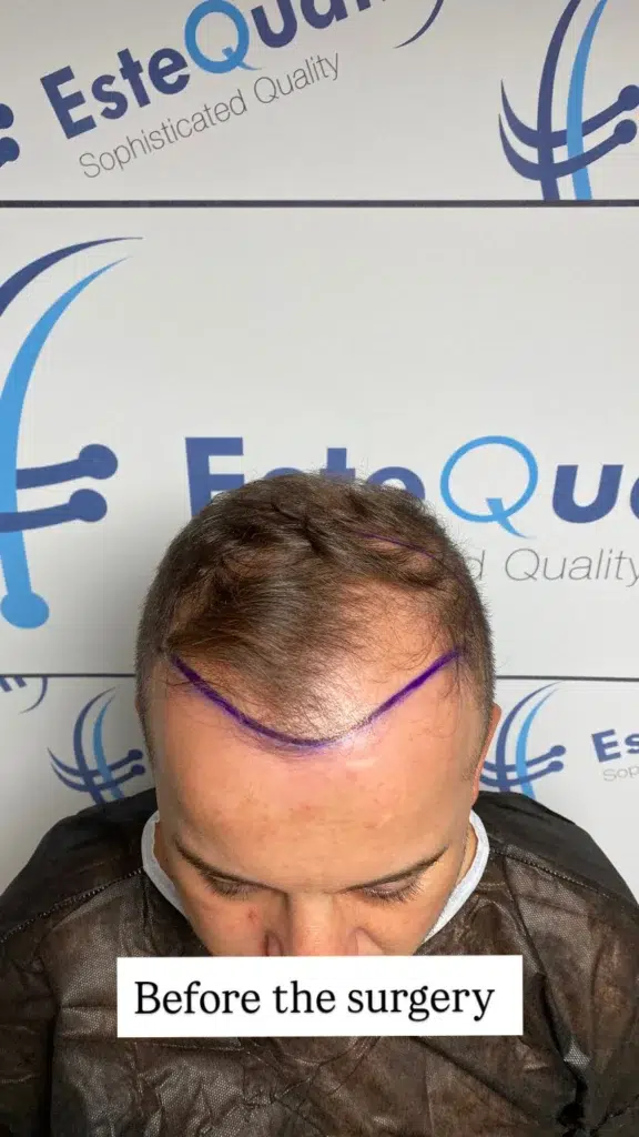 Diseño de la línea capilar frontal y planificación de implantación para un paciente con cabello con adelgazamiento en EsteQuality, utilizando 5.700 injertos para máxima densidad.