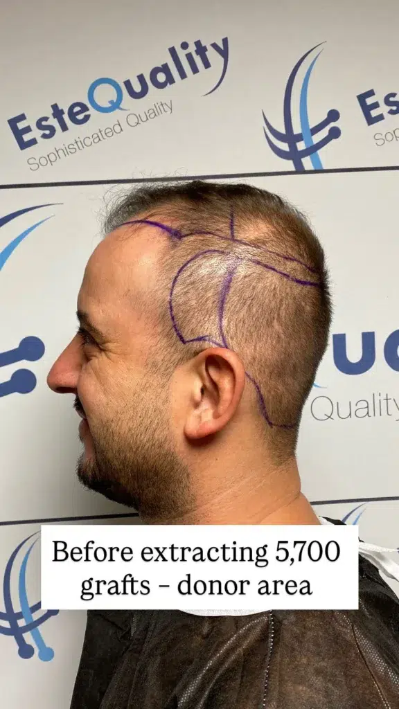 Vista inmediata posterior a la extracción de la zona donante en EsteQuality, mostrando el patrón homogéneo Micro-FUE que permite extraer 5.700 injertos de forma segura en cabello fino.