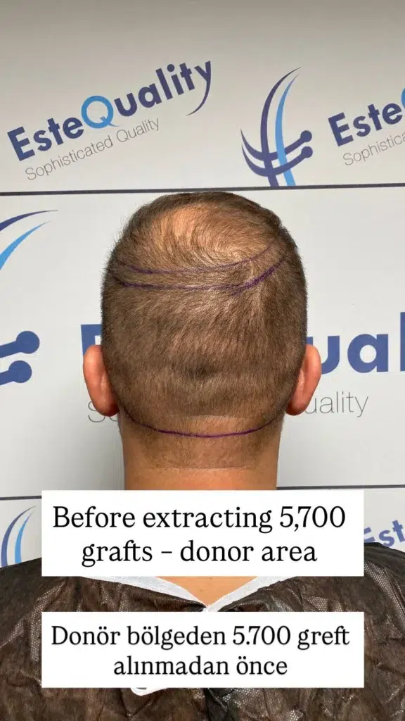Mapeo profesional de la zona donante en EsteQuality, mostrando cómo se planifican estratégicamente 5.700 injertos para un paciente con cabello fino y con adelgazamiento.