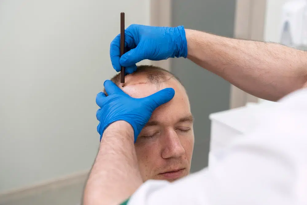 A smiling EsteQuality patient showing high-density results after a 5,700 graft hair transplant for fine hair, proving that successful restoration for thinning hair is possible.