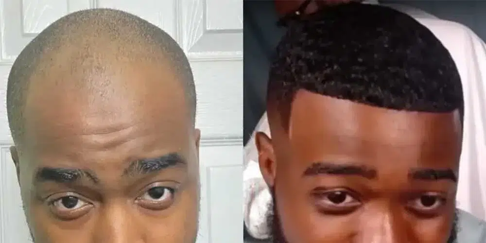 jidion hair transplant