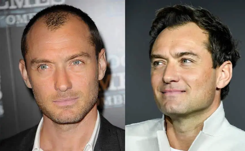 ude Law has never confirmed getting a hair transplant