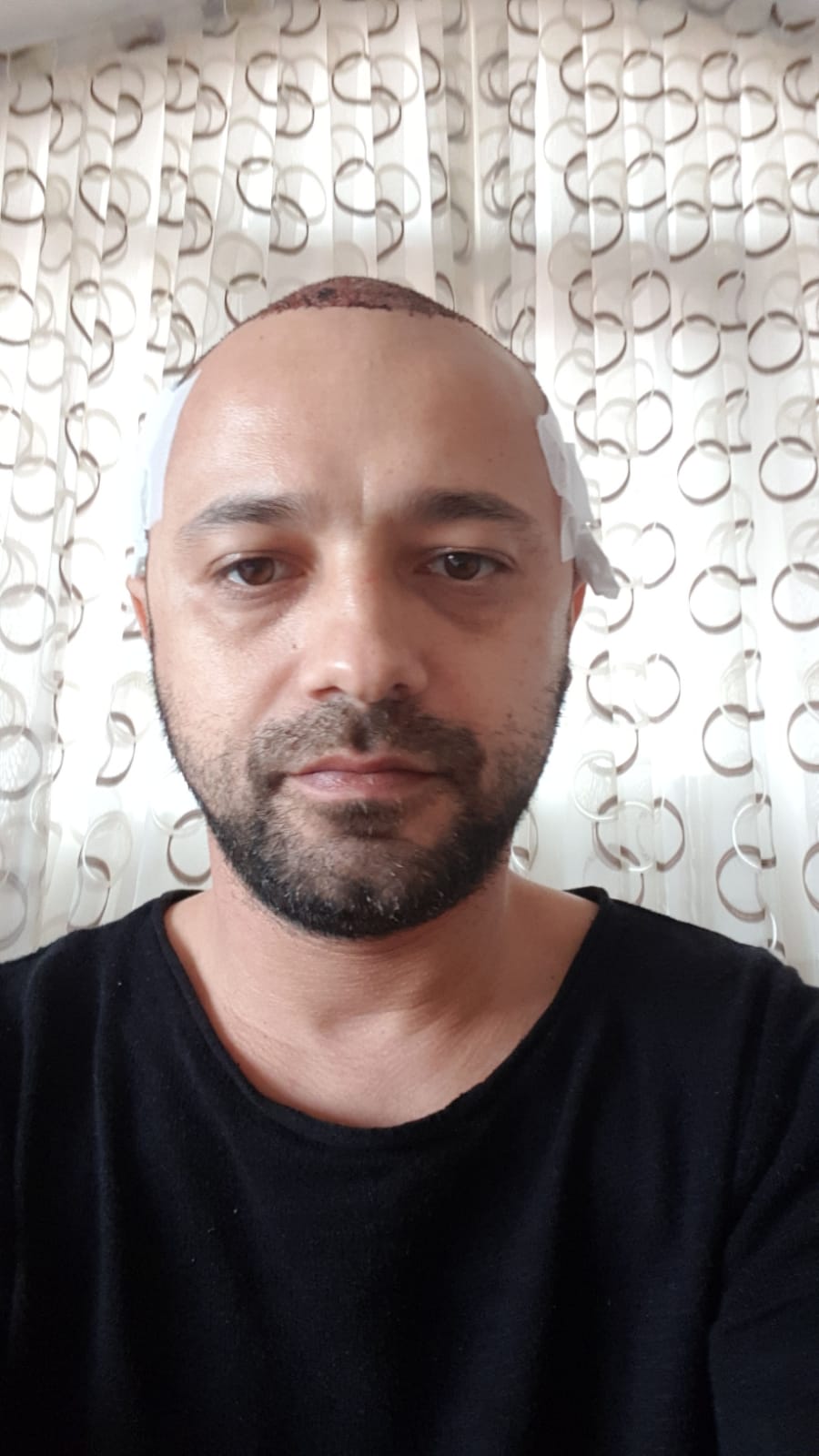Заживление после пересадки волос день 1 – ранняя фаза заживления с образованием корочек и первыми признаками заживления