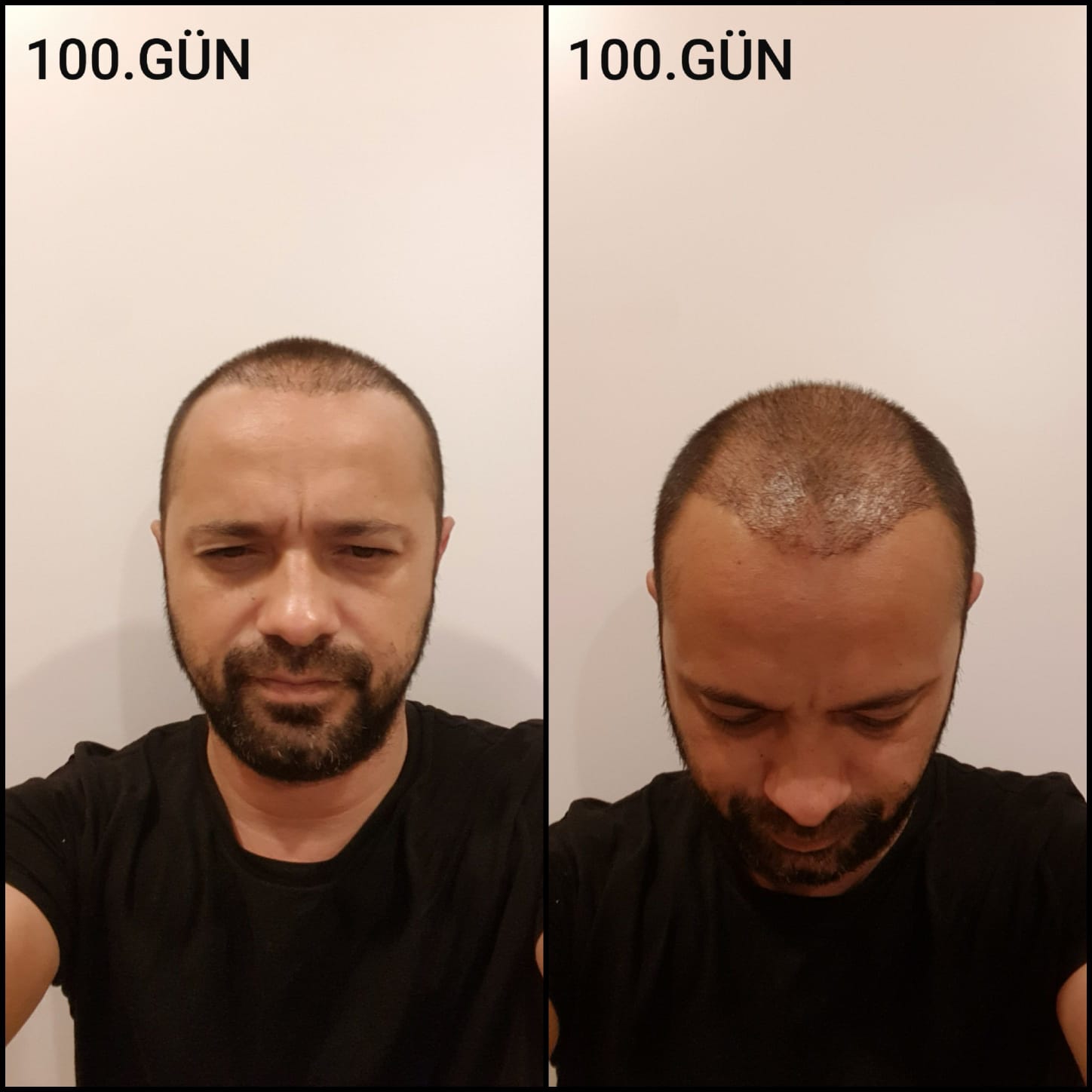 Заживление после пересадки волос день 100 – средняя фаза заживления с шоковым выпадением и дальнейшим процессом заживления