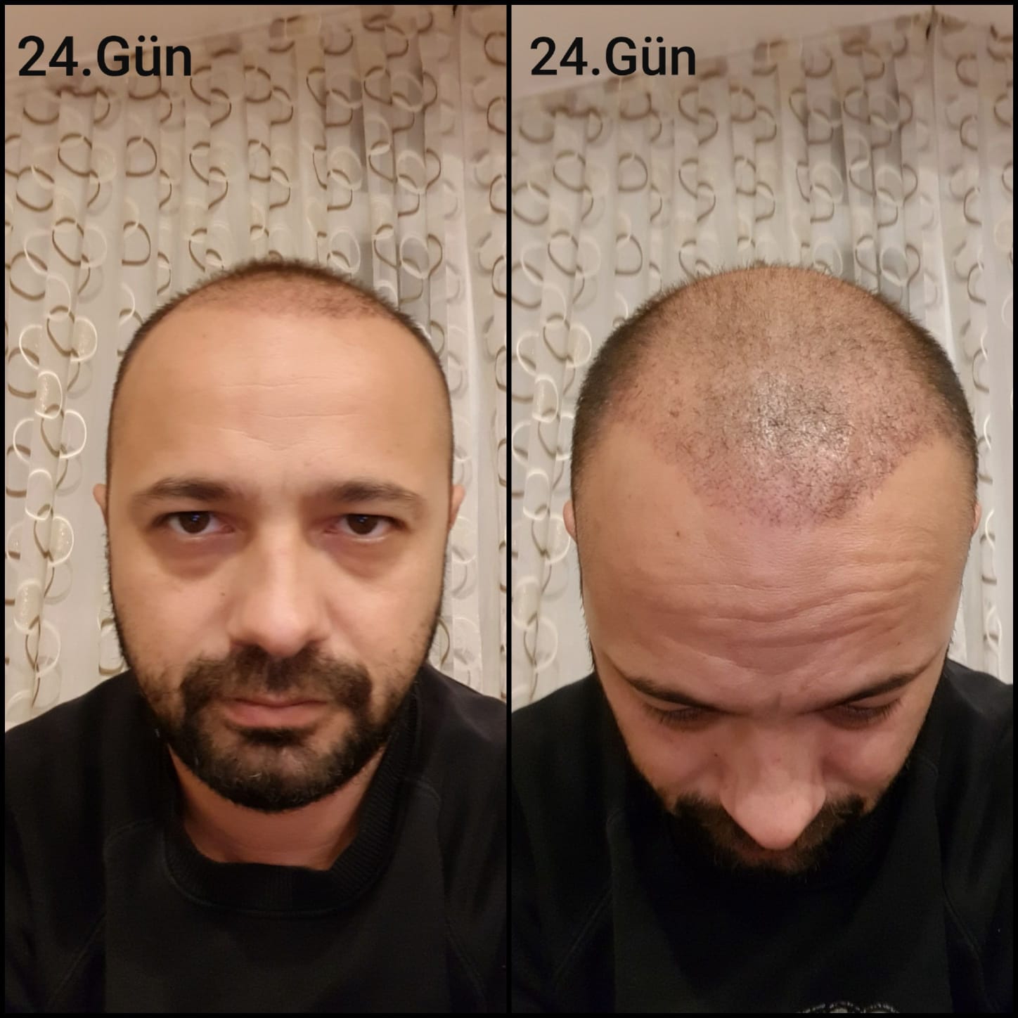 Заживление после пересадки волос день 24 – ранняя фаза заживления с образованием корочек и первыми признаками заживления