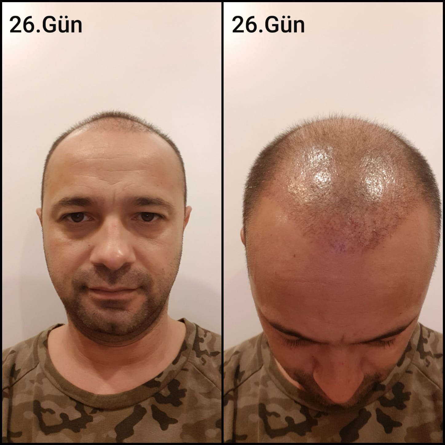 Заживление после пересадки волос день 26 – ранняя фаза заживления с образованием корочек и первыми признаками заживления