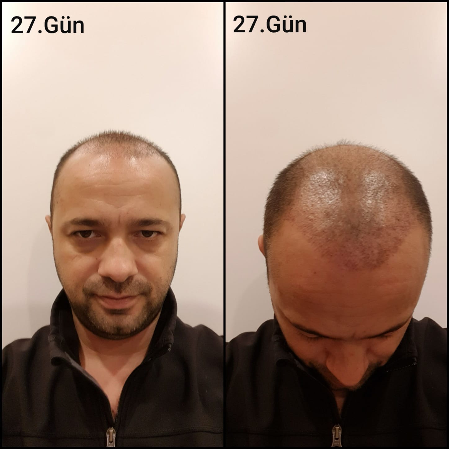Заживление после пересадки волос день 27 – ранняя фаза заживления с образованием корочек и первыми признаками заживления