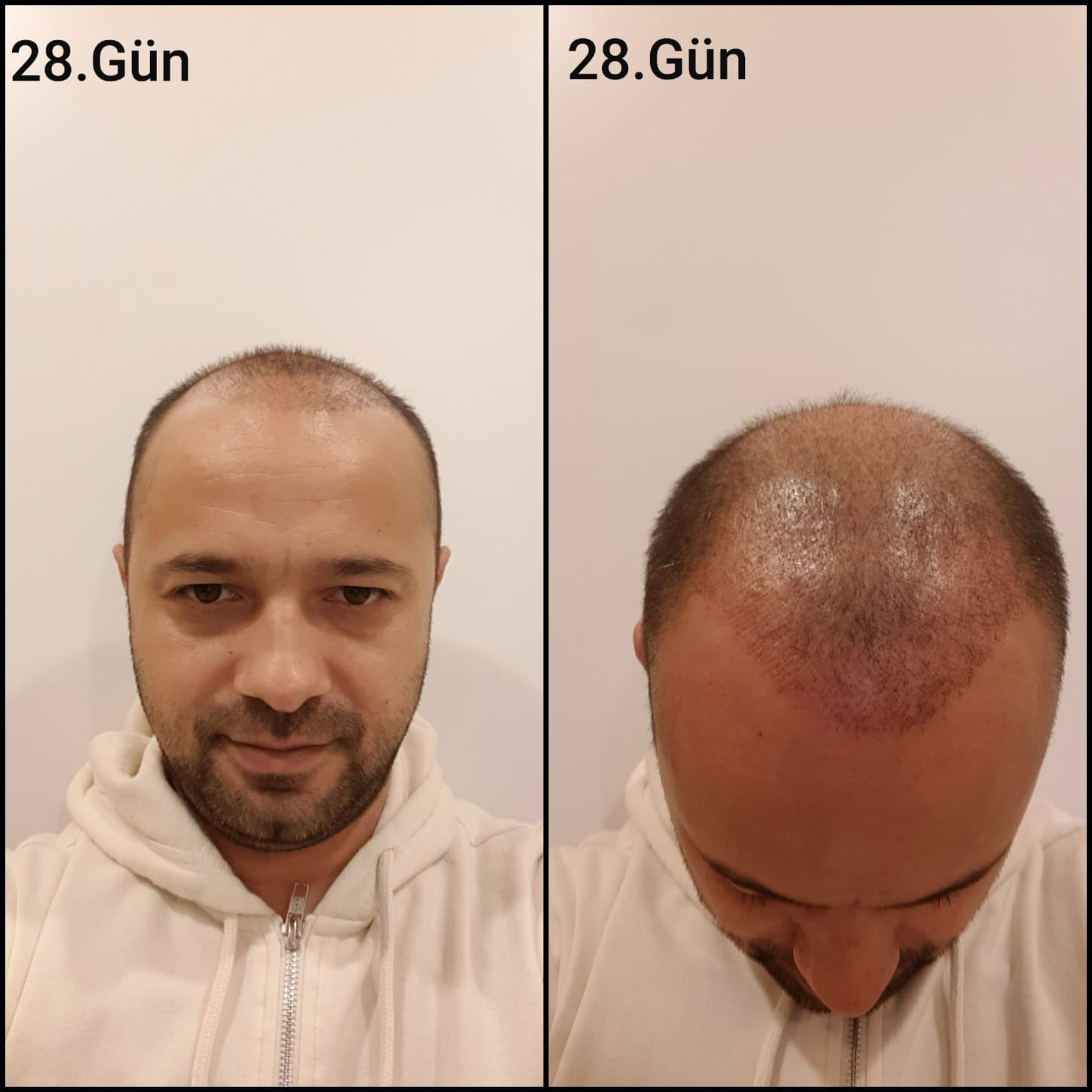 Заживление после пересадки волос день 28 – ранняя фаза заживления с образованием корочек и первыми признаками заживления