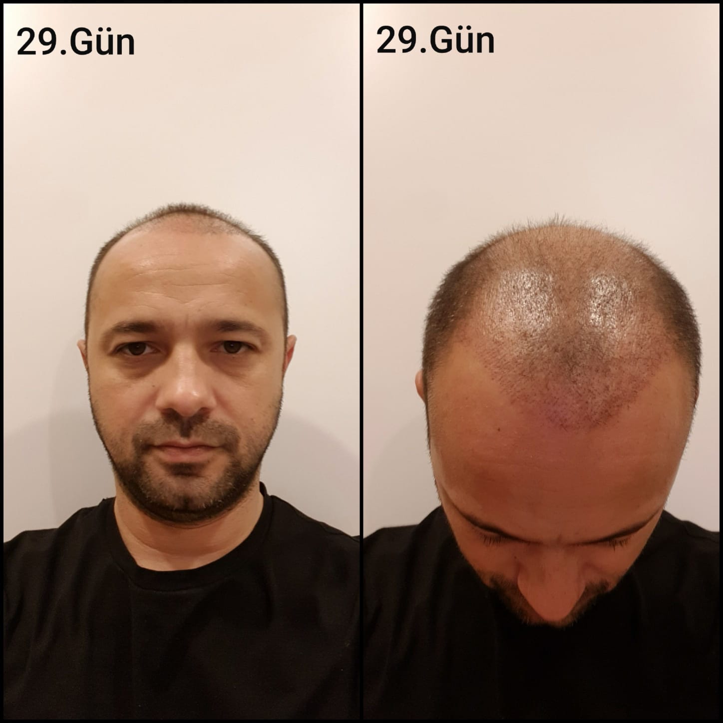 Заживление после пересадки волос день 29 – ранняя фаза заживления с образованием корочек и первыми признаками заживления