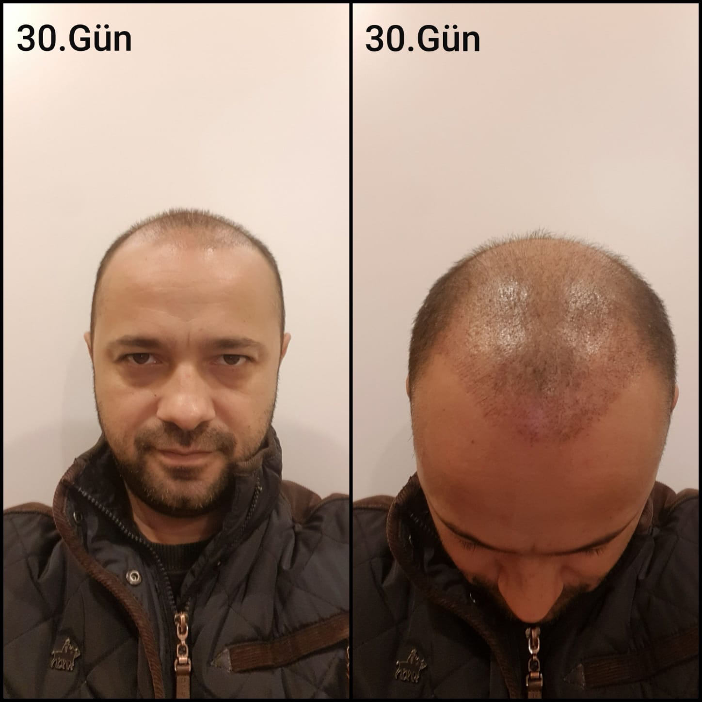 Заживление после пересадки волос день 30 – ранняя фаза заживления с образованием корочек и первыми признаками заживления