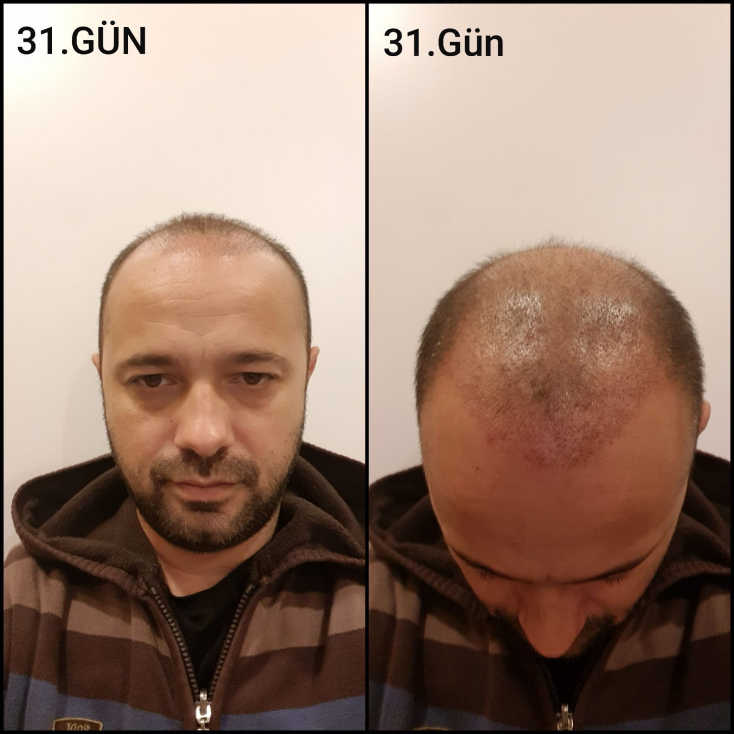 Заживление после пересадки волос день 31 – средняя фаза заживления с шоковым выпадением и дальнейшим процессом заживления