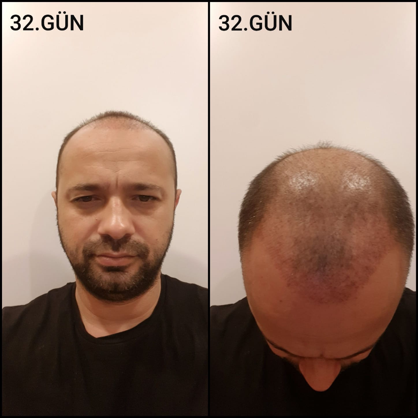 Заживление после пересадки волос день 32 – средняя фаза заживления с шоковым выпадением и дальнейшим процессом заживления