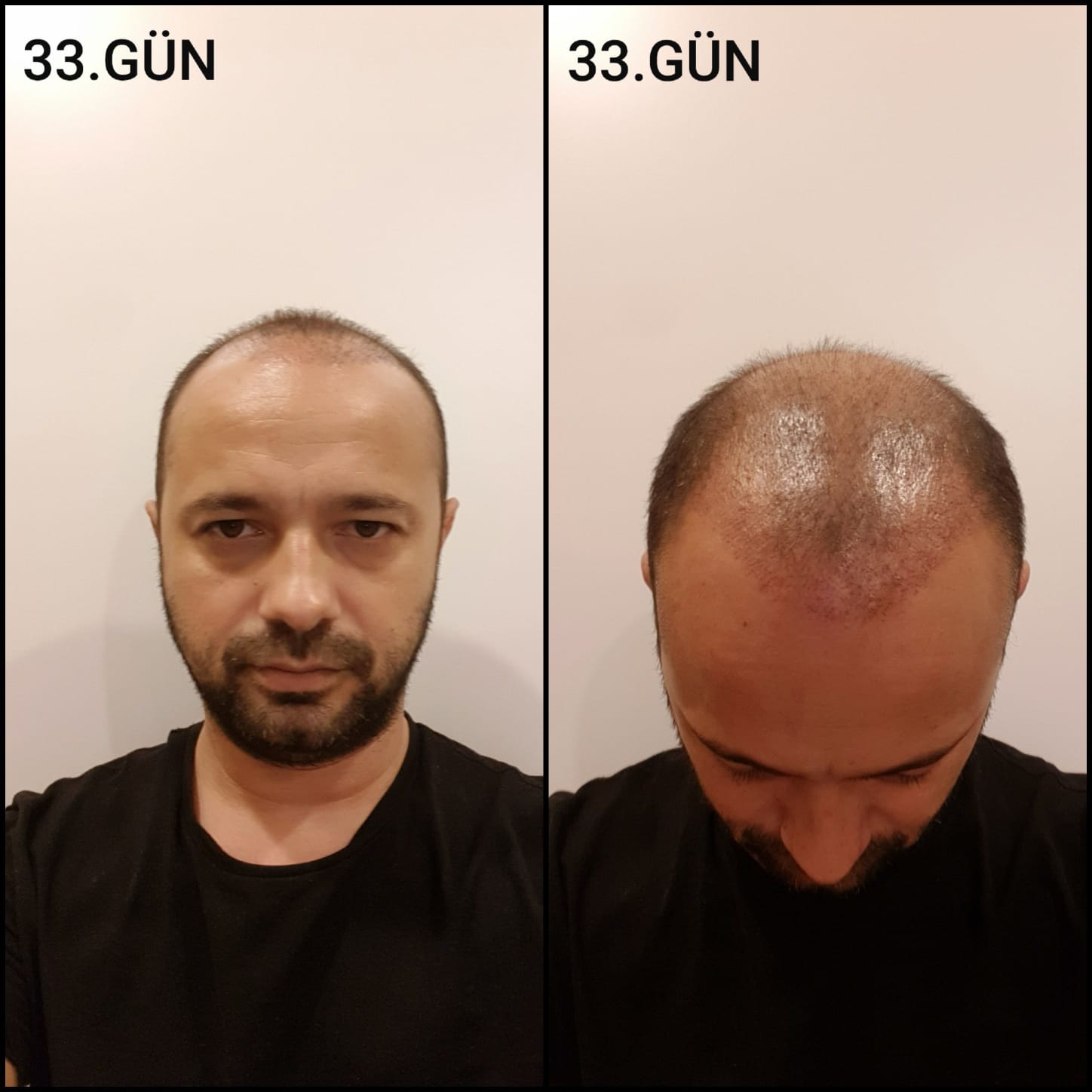 Заживление после пересадки волос день 33 – средняя фаза заживления с шоковым выпадением и дальнейшим процессом заживления