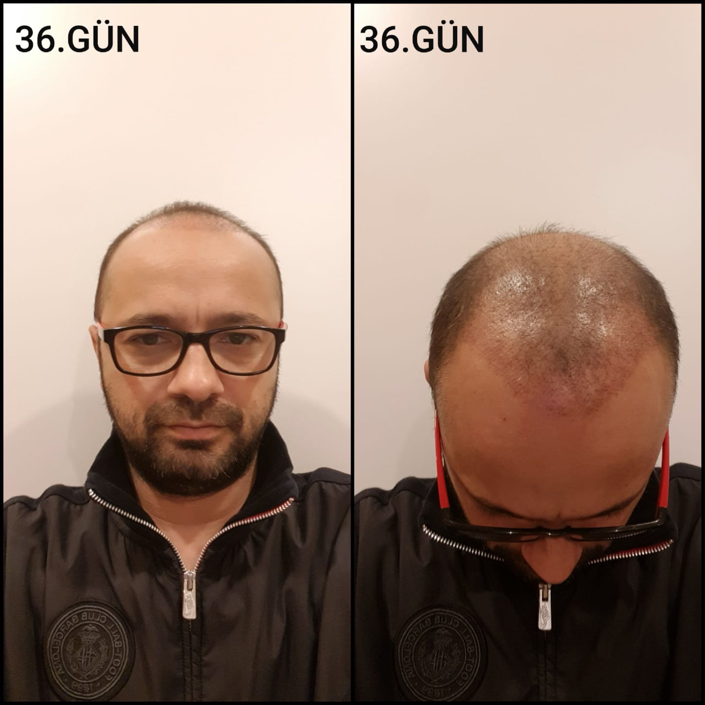 Заживление после пересадки волос день 36 – средняя фаза заживления с шоковым выпадением и дальнейшим процессом заживления