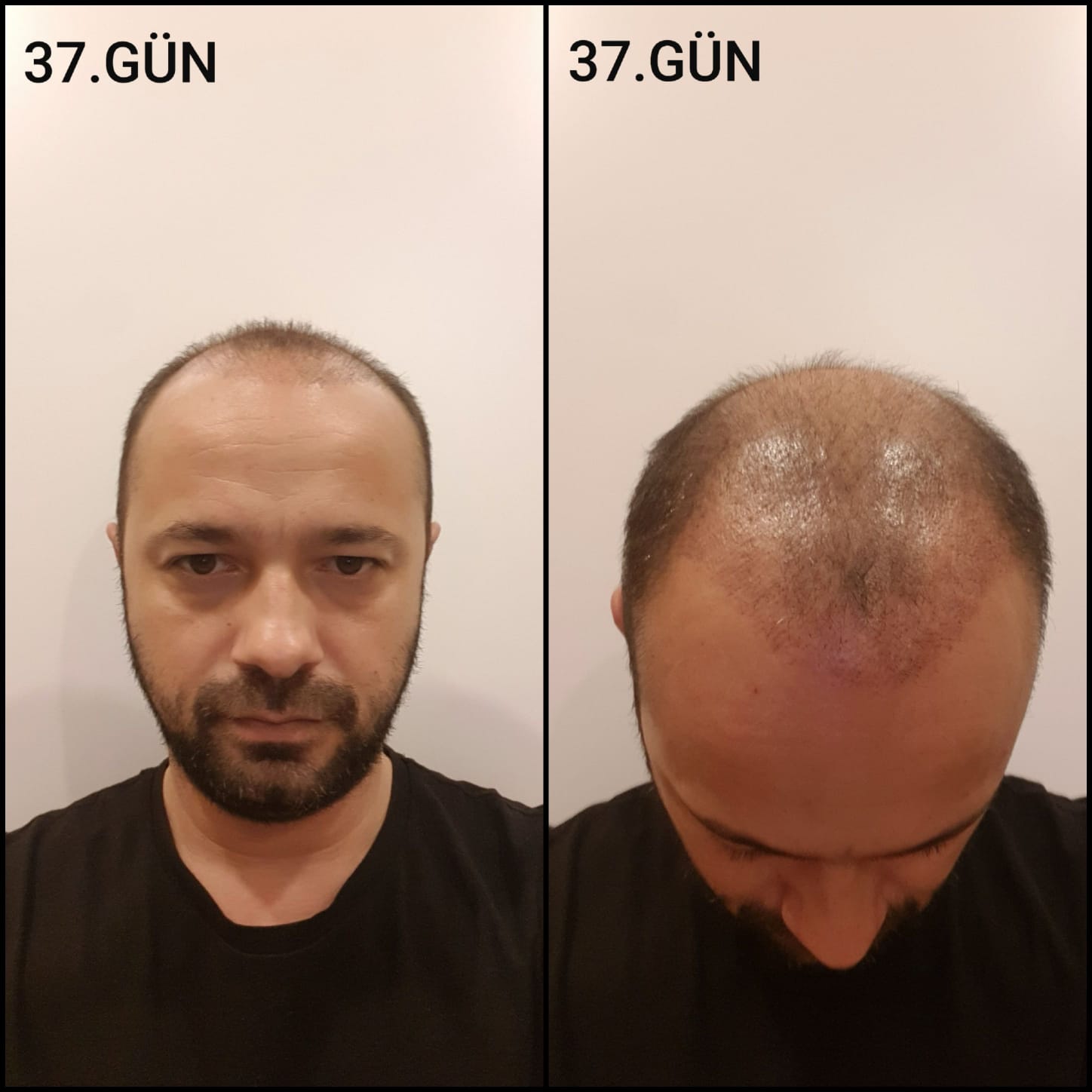 Заживление после пересадки волос день 37 – средняя фаза заживления с шоковым выпадением и дальнейшим процессом заживления